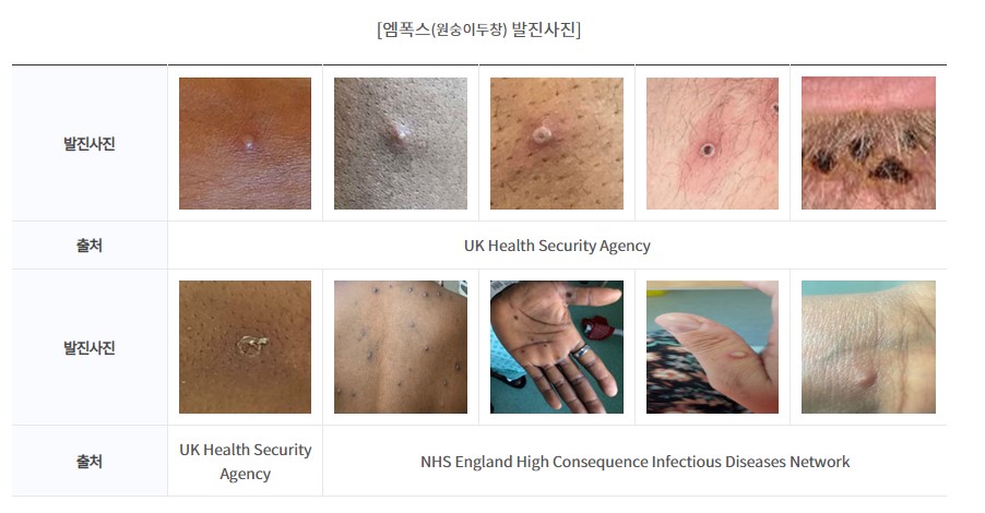 충북서 '엠폭스' 의심환자 3건 접수